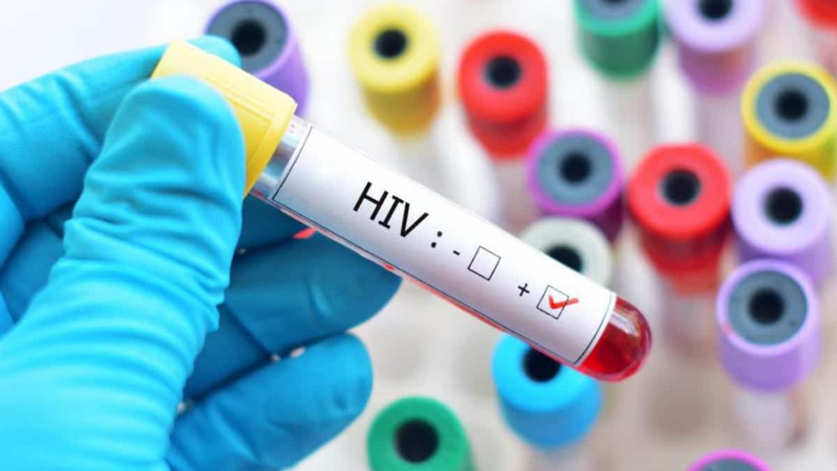 Variantă virulentă a HIV descoperită în Olanda