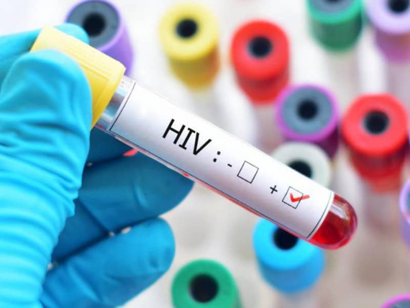 variantă virulentă a hiv descoperită în olanda