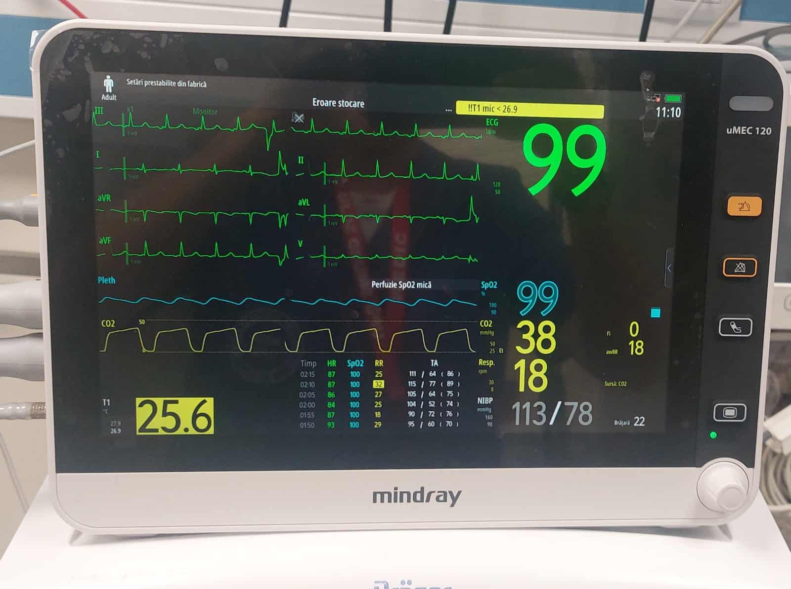 Spitalul Județean Sibiu a primit un monitor multiparametric avansat pentru Camera de Resuscitare